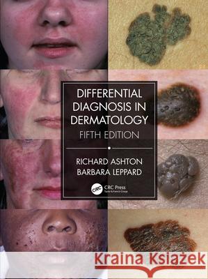 Differential Diagnosis in Dermatology Richard Ashton Barbara Leppard 9780367085988 CRC Press