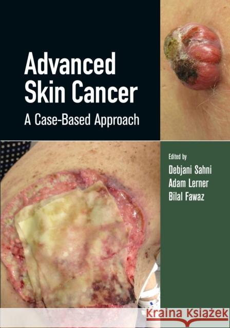 Advanced Skin Cancer: A Case-Based Approach Sahni, Debjani 9780367134716 Taylor & Francis Ltd