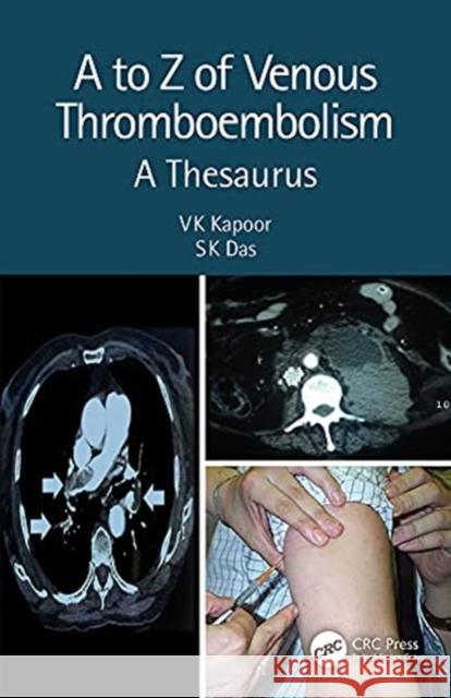 A to Z of Venous Thromboembolism: A Thesaurus Kapoor, Vk 9780367220334 CRC Press