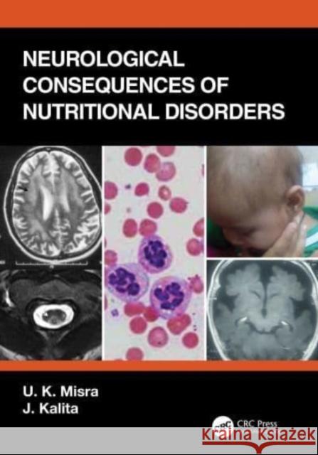 Neurological Consequences of Nutritional Disorders U. K. Misra J. Kalita 9780367313449 CRC Press