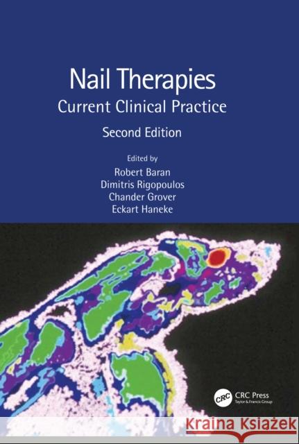 Nail Therapies: Current Clinical Practice Robert Baran Dimitris Rigopoulos Chander Grover 9780367334796