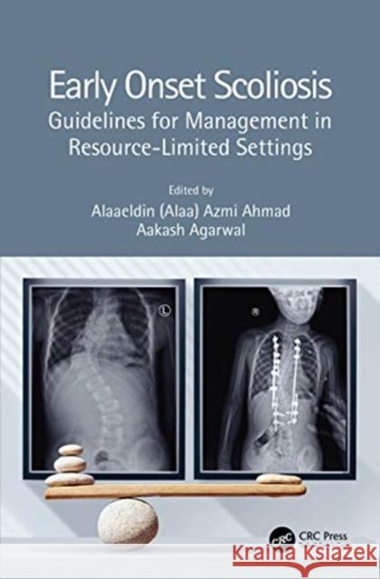 Early Onset Scoliosis: Guidelines for Management in Resource-Limited Settings Alaaeldin (Alaa) Azmi Ahmad Aakash Agarwal 9780367370312 CRC Press