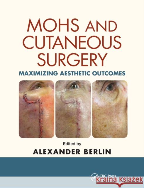Mohs and Cutaneous Surgery: Maximizing Aesthetic Outcomes Alexander Berlin 9780367378172 CRC Press