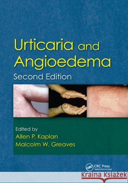 Urticaria and Angioedema Allen Kaplan Malcolm W. Greaves 9780367385941