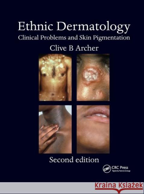 Ethnic Dermatology: Clinical Problems and Skin Pigmentation Clive B. Archer 9780367386634