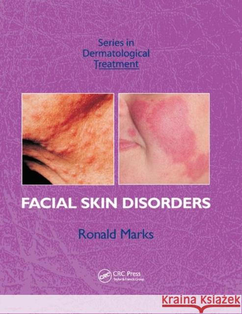 Facial Skin Disorders Ronald Marks 9780367389390 CRC Press