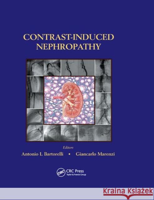 Contrast-Induced Nephropathy in Interventional Cardiovascular Medicine Antonio L. Bartorelli Giancarlo Marenzi 9780367391751