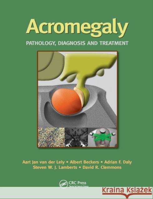 Acromegaly: Pathology, Diagnosis and Treatment Aart Jan Va Albert Beckers Adrian Daly 9780367392581 CRC Press