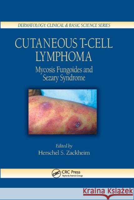 Cutaneous T-Cell Lymphoma: Mycosis Fungoides and Sezary Syndrome Herschel S. Zackheim 9780367393670 CRC Press