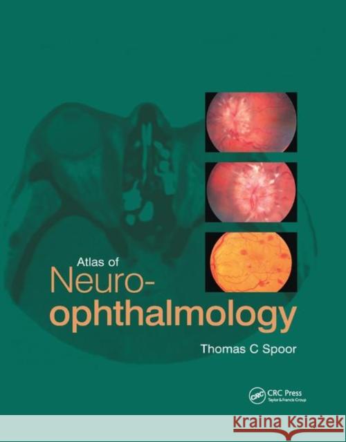 Atlas of Neuro-Ophthalmology Thomas C. Spoor 9780367394349