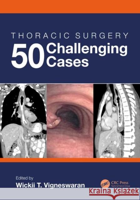 Thoracic Surgery: 50 Challenging Cases: 50 Challenging Cases Vigneswaran, Wickii 9780367408329 CRC Press