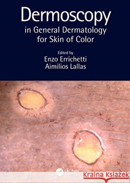 Dermoscopy in General Dermatology for Skin of Color Enzo Errichetti Aimilios Lallas 9780367418403 CRC Press
