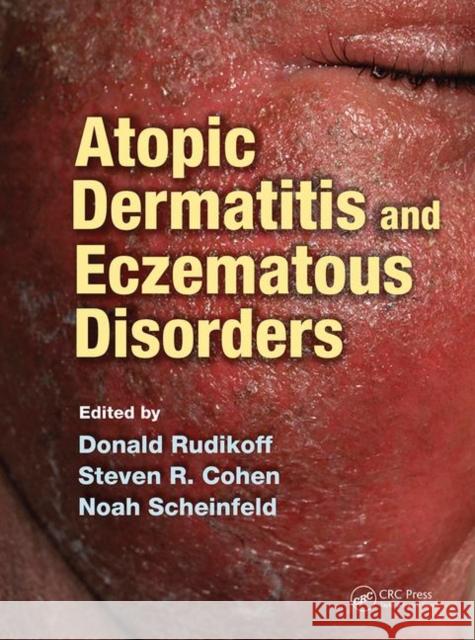 Atopic Dermatitis and Eczematous Disorders Donald Rudikoff, MD (Chief of Dermatolog Steven R Cohen (Professor and Chief, Div Noah Scheinfeld (Weill Cornell Medical 9780367452162