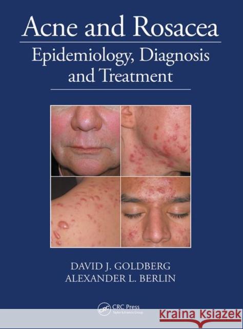 Acne and Rosacea: Epidemiology, Diagnosis and Treatment David J. Goldberg Alexander Berlin  9780367452216 CRC Press