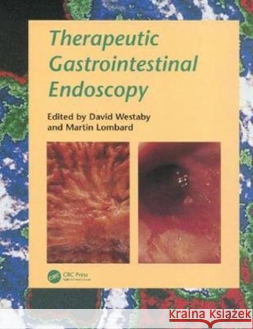 Therapeutic Gastrointestinal Endoscopy a Problem-Oriented Approach Westaby, David 9780367455088 CRC Press