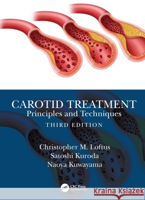 Carotid Treatment: Principles and Techniques Christopher M. Loftus Satoshi Kuroda Naoya Kuwayama 9780367465711 Taylor & Francis Ltd