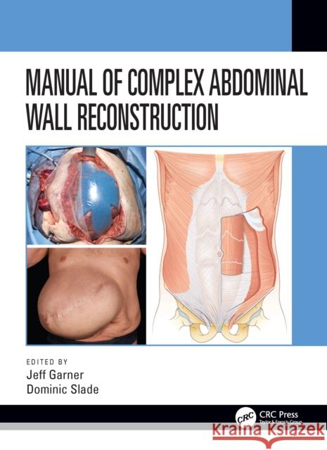 Manual of Complex Abdominal Wall Reconstruction Jeff Garner Dominic Slade 9780367485870 CRC Press