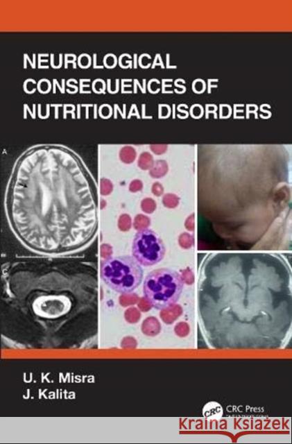 Neurological Consequences of Nutritional Disorders U. K. Misra J. Kalita 9780367543068 CRC Press