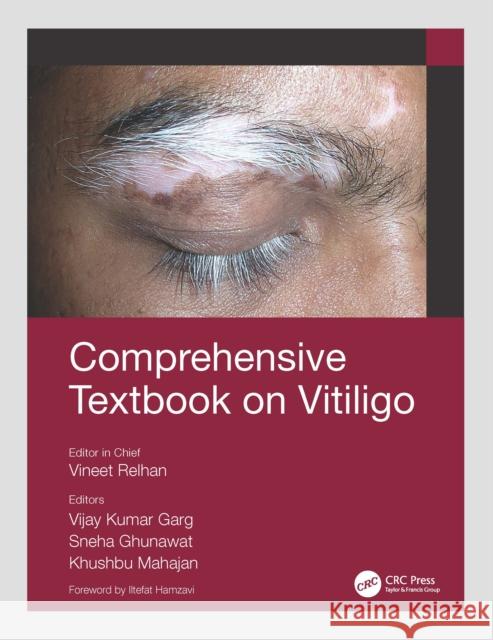 Comprehensive Textbook on Vitiligo Vineet Relhan Vijay Kumar Garg Sneha Ghunawat 9780367543723 CRC Press