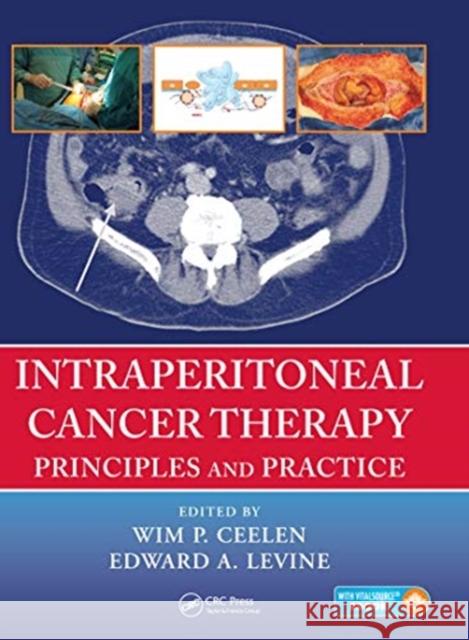 Intraperitoneal Cancer Therapy: Principles and Practice Wim P. Ceelen Edward Levine 9780367575250 CRC Press