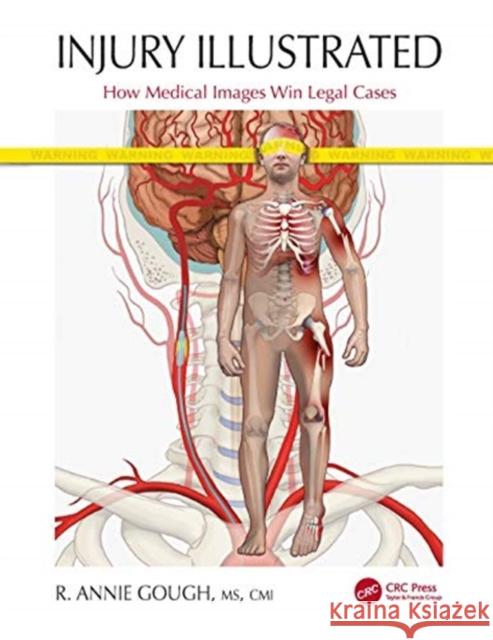 Injury Illustrated: How Medical Images Win Legal Cases R. Annie Gough 9780367615338 CRC Press