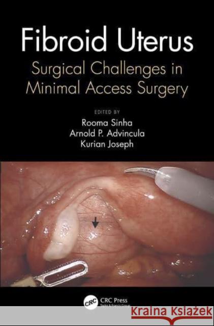 Fibroid Uterus: Surgical Challenges in Minimal Access Surgery Rooma Sinha (Apollo Hospitals, Hyderabad Kurian Joseph (Joseph Hospitals, Chennai Arnold Advincula (Columbia University  9780367620554 CRC Press