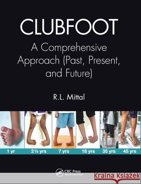 Clubfoot: A Comprehensive Approach (Past, Present, and Future) R. L. Mittal 9780367656010 CRC Press