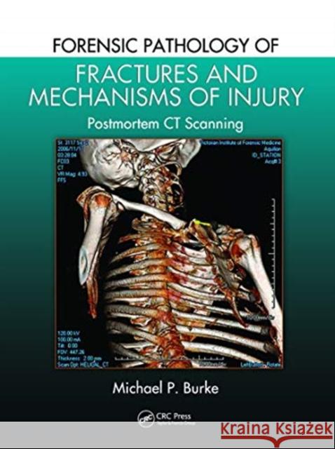 Forensic Pathology of Fractures and Mechanisms of Injury: Postmortem CT Scanning Burke, Michael P. 9780367778194