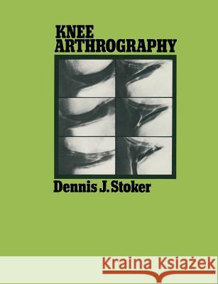 Knee Arthrography Dennis J. Stoker 9780412218606 Springer