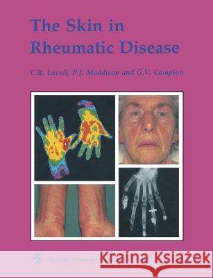 The Skin in Rheumatic Disease C. R. Lovell P. J. Maddison Giles Campion 9780412290008 Springer