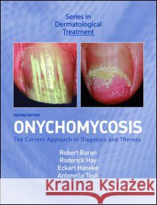 Onychomycosis: The Current Approach to Diagnosis and Therapy Baran, Robert 9780415385794 Taylor & Francis Group