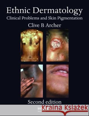 Ethnic Dermatology: Clinical Problems and Skin Pigmentation Clive B. Archer 9780415471190