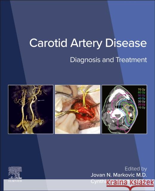 Carotid Artery Disease Cynthia K. Shortell Jovan N. Markovic 9780443138652 Elsevier Science Publishing Co Inc