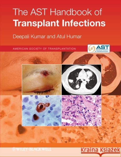 The Ast Handbook of Transplant Infections Kumar, Deepali 9780470658277 