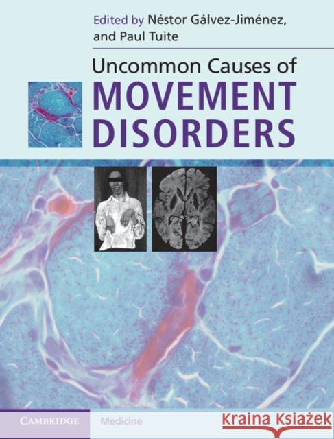 Uncommon Causes of Movement Disorders Nestor Galvez-Jimenez 9780521111546 0