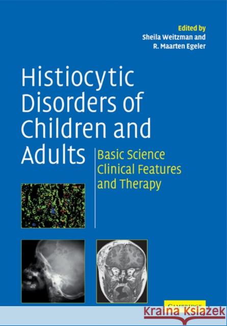 Histiocytic Disorders of Children and Adults: Basic Science, Clinical Features and Therapy Weitzman, Sheila 9780521184168