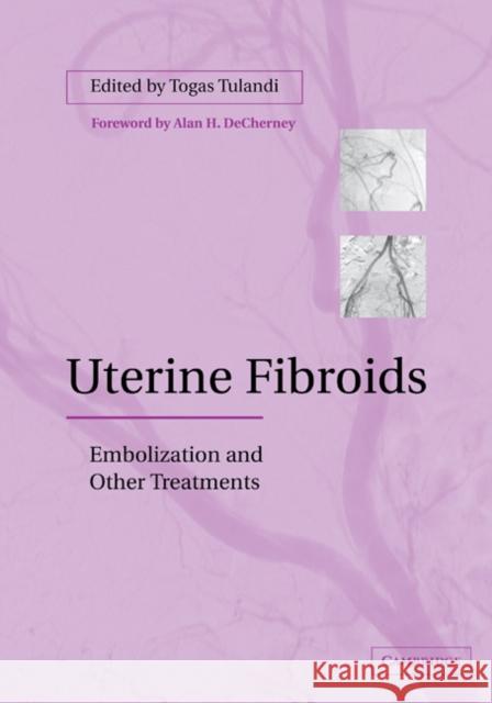 Uterine Fibroids: Embolization and Other Treatments Tulandi, Togas 9780521184199 Cambridge University Press