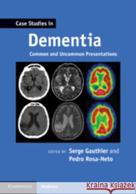 Case Studies in Dementia: Volume 1: Common and Uncommon Presentations Gauthier, Serge 9780521188302
