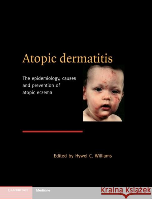 Atopic Dermatitis: The Epidemiology, Causes and Prevention of Atopic Eczema Hywel C. Williams (University of Nottingham) 9780521570756 Cambridge University Press