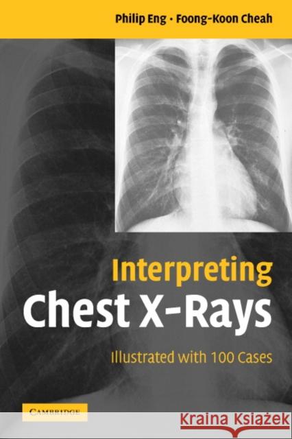 Interpreting Chest X-Rays: Illustrated with 100 Cases Philip Eng, Foong-Koon Cheah 9780521607322 Cambridge University Press