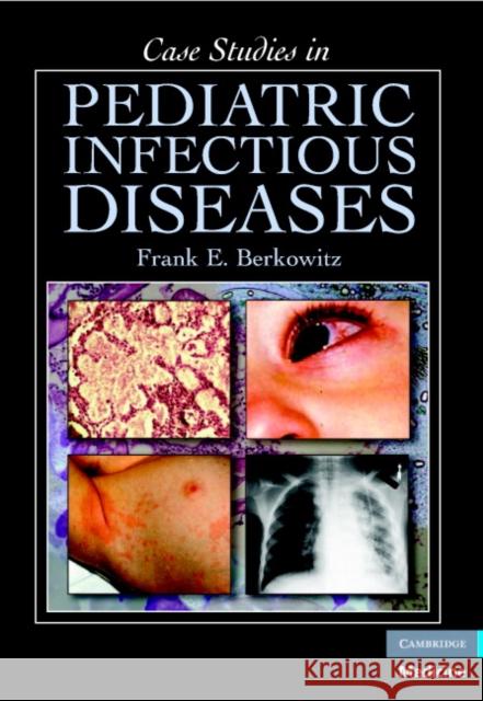 Case Studies in Pediatric Infectious Diseases Frank E. Berkowitz 9780521697613 Cambridge University Press