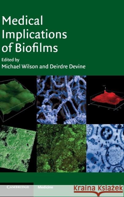 Medical Implications of Biofilms Michael Wilson (University College London), Deirdre Devine (Leeds Dental Institute, University of Leeds) 9780521812405