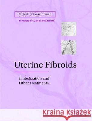 Uterine Fibroids: Embolization and other Treatments Togas Tulandi (McGill University, Montréal) 9780521819381 Cambridge University Press