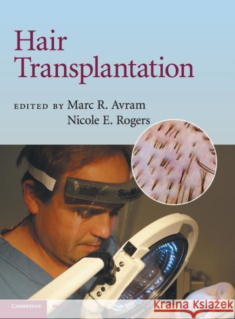 Hair Transplantation Marc R Avram 9780521879675 0