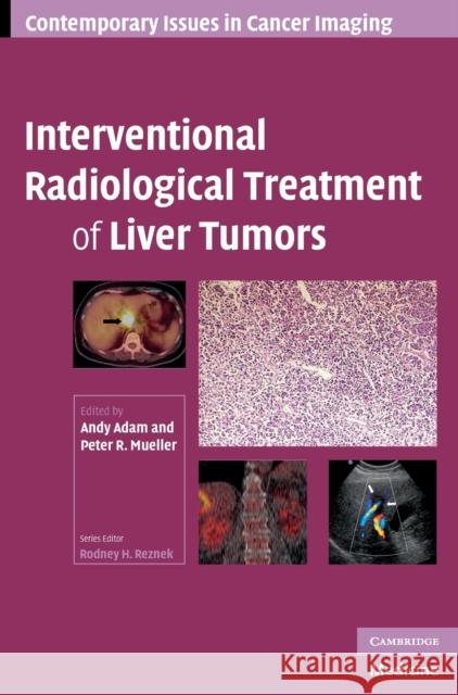 Interventional Radiological Treatment of Liver Tumors  9780521886871 CAMBRIDGE UNIVERSITY PRESS