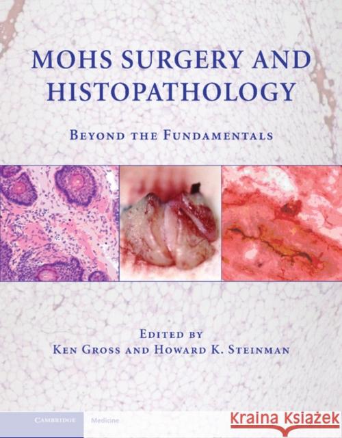 Mohs Surgery and Histopathology: Beyond the Fundamentals Gross, Ken 9780521888042 0