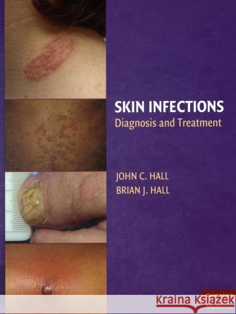 Skin Infections: Diagnosis and Treatment Hall, John C. 9780521897297 0