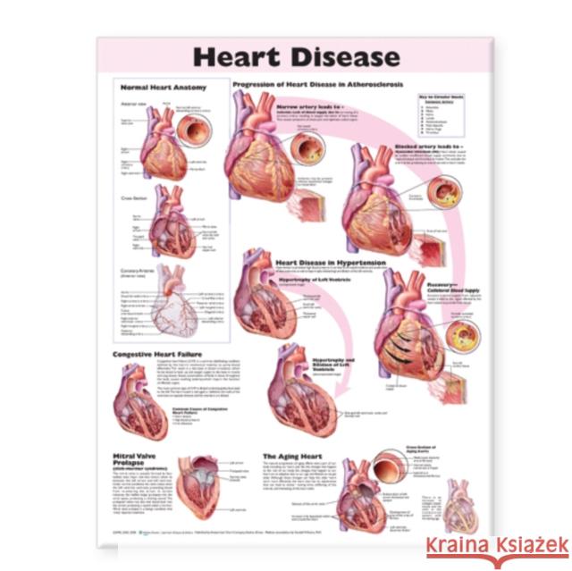 Heart Disease Anatomical Chart  Anatomical Chart Company 9780781773379 0