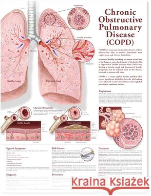 Chronic Obstructive Pulmonary Disease Anatomical Chart Acc                                      Anatomical Chart Company 9780781782364 Lippincott Williams & Wilkins