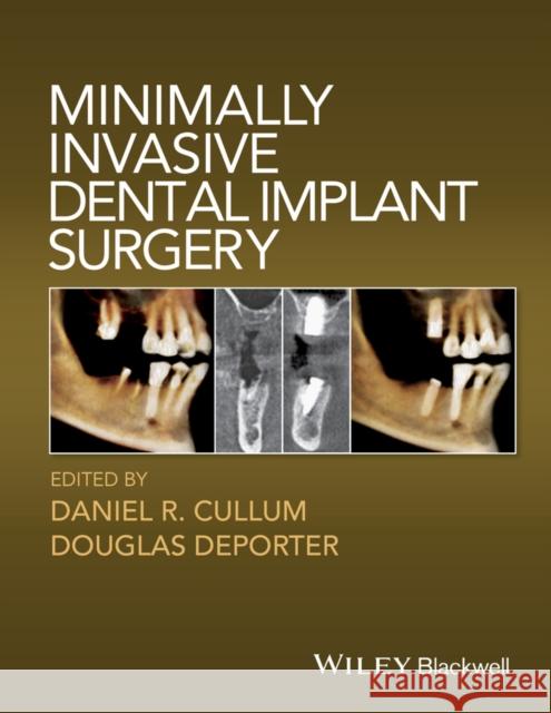 Minimally Invasive Dental Implant Surgery Cullum, Daniel R.; Deporter, Douglas 9780813814520 